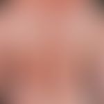 Pemphigus vulgaris, Stadium der Generalisation. multiple, chronische, seit 3 Jahren schubweise ve...
