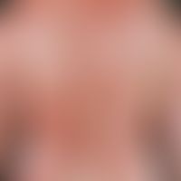 Pemphigus vulgaris, Stadium der Generalisation. multiple, chronische, seit 3 Jahren schubweise ve...
