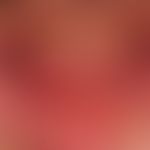 Pemphigus vulgaris (lokalisiertes Stadium): chronisch persistierende flächenhafte, schmerzhafte E...