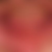 Pemphigus vulgaris (lokalisiertes Stadium): chronisch persistierende flächenhafte, schmerzhafte E...