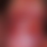Penis carcinoma: reddened plaque in the area of the glans penis with formation of coarse, verruco...
