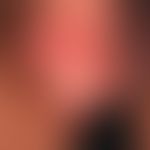 Peniskarzinom:&nbsp; plattenartige derbe Infiltration der Glans penis mit flächiger Fibrin-bedeck...