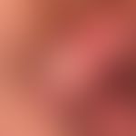Peniskarzinom:&nbsp; umschriebene, wenig schmerzende, harte Knotenbildung mit flächiger UIzeratio...