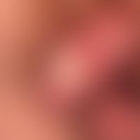 Penis carcinoma: circumscribed, slightly painful, hard knot formation with extensive ulceration o...