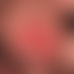 Peniskarzinom:&nbsp; wulstige Knotenbildung der Glans penis. Deutliche seit "mehreren" Jahren bes...