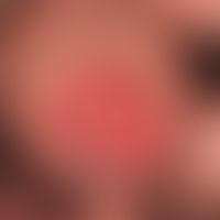 Penis carcinoma: bulging nodules of the glans penis; distinct phimosis that has existed for "seve...