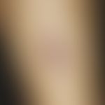 Polyarteriitis nodosa, systemische. Nahaufnahme: Zackig begrenztes, tief reichendes, mit Fibrin b...