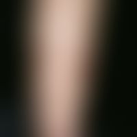 Polyarteritis nodosa, systemic, multiple, chronically dynamic, since 2 years steadily increasing,...