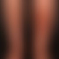 Kutane Polyarteriitis nodosa: seit Jahren bestehende, hochschmerzhafte teigig indurierte Plaques&...