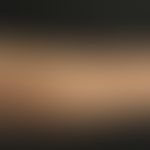 Keratosis pilaris syndrome: Numerous follicularly bound papules in the area of the forearm in the...