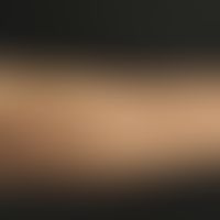 Keratosis pilaris-Syndrom:&nbsp;zahlreiche, follikulär gebundene Papeln im Bereich des Unterarmes...