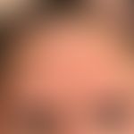 Keratosis pilaris syndrome. persistent symmetrical facial erythema as well as small, follicularly...