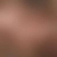 Keratosis pilaris syndrome. inflammatory, follicularly bound papules in the area of the capilliti...