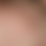 Keratosis pilaris syndrome. Inflammatory follicularly bound papules in the area of the hairline o...