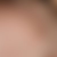 Keratosis pilaris-Syndrom:&nbsp;entzündliche, follikulär gebundene Papeln im Bereich des Haaransa...