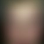 keratosis pilaris syndrome. keratosis pilaris syndrome with ulerythema ophryogenes. small, follic...
