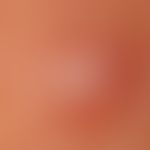 Candle spot phenomenon. reflected light microscopy (without optical contact medium): image of the...