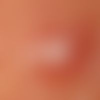 Candle spot phenomenon. reflected light microscopy (without optical contact medium): image of the...