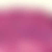 Klarzellenakanthom: breites, zum re. Bildrand hin scharf abgesetztes, netzartig verzweigtes, akan...