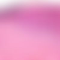 Klarzellenakanthom. Übergangszone zur normalen Haut (im Bild links): Breites, akanthotisches Epit...