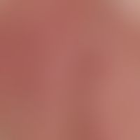 Klarzellenakanthom. Auflichtmikroskopie (Ausschnitt, Läsion am Unterschenkel): Basisarchitektur a...