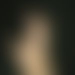 Indolente coarse, isolated and aggregated nodes in the area of the finger extensor sides in chron...