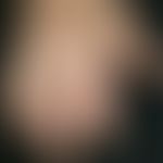 Rheumatic nodules. skin-coloured, smooth, non-painful, movable nodules. Occurs not only at the di...