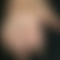 Rheumatic nodules. skin-coloured, smooth, non-painful, movable nodules. Occurs not only at the di...