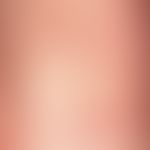 Köbner phenomenon: Striped, red papules of the lichen planus in the area of the wrist bend, appea...