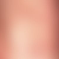 Köbner phenomenon: Striped, red papules of the lichen planus in the area of the wrist bend, appea...