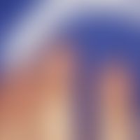 Koilonychia: Bowl-shaped indentation of the nail plates which are detached at the edge in a healt...