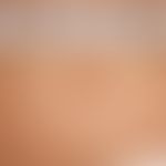Nevus, cocard nevus, cocard-like arranged brown shades of a congenital, melanocytic nevus in the ...