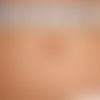 Nevus, cocard nevus, cocard-like arranged brown shades of a congenital, melanocytic nevus in the ...