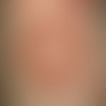 Edema, infantile, acute, hemorrhagic. Smaller and larger, disc-like configured, hemorrhagic, litt...