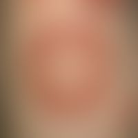 Edema, infantile, acute, hemorrhagic. Smaller and larger, disc-like configured, hemorrhagic, litt...