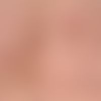 Collagenosis, reactive perforating. 12-month-old female patient: Itchy papules with a central dep...