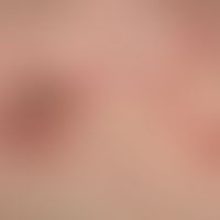 Collagenosis, reactive perforating. detail enlargement: solitary, 0.3-1.3 cm large, red papules w...
