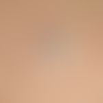 Comedo: approx.0.4 cm large, flat raised, firm papule with an approx. 0.1 cm large, black, kerato...