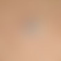 Comedo: approx.0.4 cm large, flat raised, firm papule with an approx. 0.1 cm large, black, kerato...