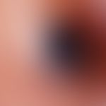 Comedo(reflected light microscopy): Blackhead comedo on the back; black horn plug surrounded by a...