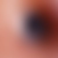 Comedo(reflected light microscopy): Blackhead comedo on the back; black horn plug surrounded by a...