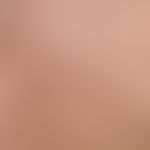 Comedones: numerous black (irritationless) comedones standing in groups with known now largely he...