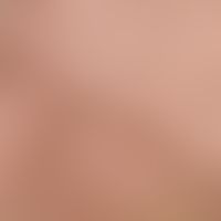 Comedones: numerous black (irritationless) comedones standing in groups with known now largely he...