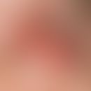 Konjunktivitis bei Erythema exsudativum multiforme. Schwerste, entzündliche, konjunktivale Mitrea...