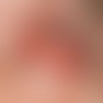 Conjunctivitis in erythema exsudativum multiforme: Severe, inflammatory, conjunctival co-reaction...