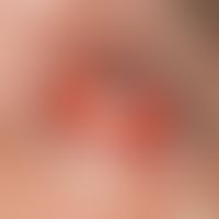 Konjunktivitis bei Erythema exsudativum multiforme. Schwerste, entzündliche, konjunktivale Mitrea...