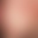 Grade 1 localized contacturticaria in the preauricular and cheek area after application of a mois...