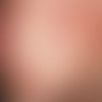 Grade 1 localized contacturticaria in the preauricular and cheek area after application of a mois...