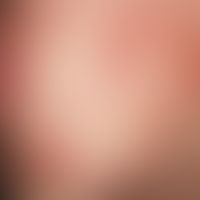 Grade 1 localized contacturticaria in the preauricular and cheek area after application of a mois...