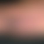 Cryoglobulinemia: Survey picture: Disseminated blue-black plaques in a reddened area caused by bl...
